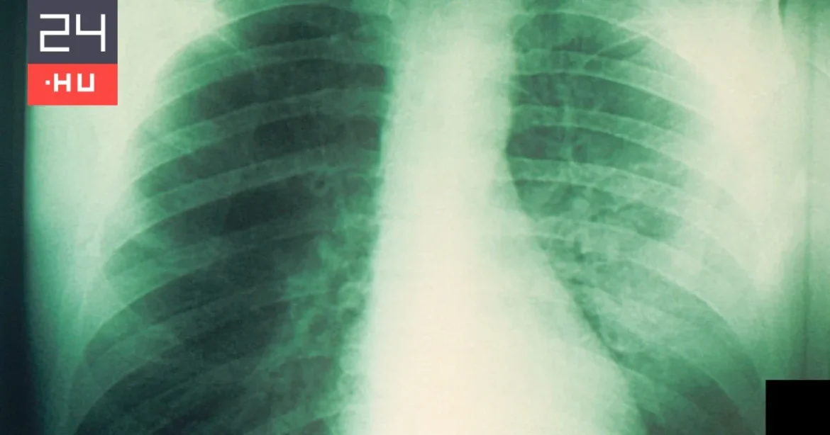A leghalálosabb pestis szökhetett meg egy orosz laborból
